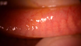 Meibomian Gland Disease