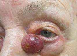 Merkel Cell Carcinoma