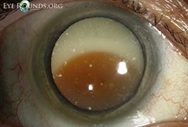 Morgagnian cataract