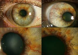 Rubeosis iridis or neovascularization of the iris in diabetes