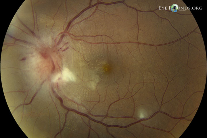 Optic Neuroretinitis Bartonella neuroretiniti week1