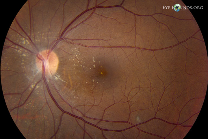 Optic Neuroretinitis Bartonella neuroretiniti week8