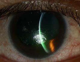 Neurotrophic Ulcer Secondary to 5th and 7th Cranial Nerve Palsies