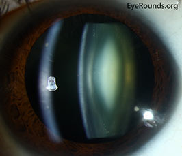 Nuclear sclerotic cataract