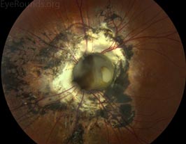 Optic nerve coloboma with staphyloma