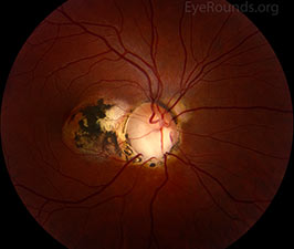 Optic nerve coloboma with peripapillary choroidal neovascular membrane