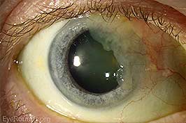 Ocular Surface Squamous Cell Carcinoma