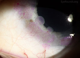 Ocular surface squamous neoplasia
