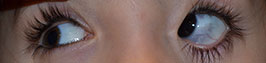 Ocular melanocytosis