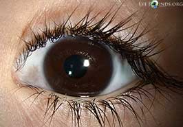 Ocular melanocytosis