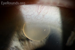 Ointment in anterior chamber after cataract surgery