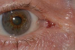Conjunctival oncocytoma