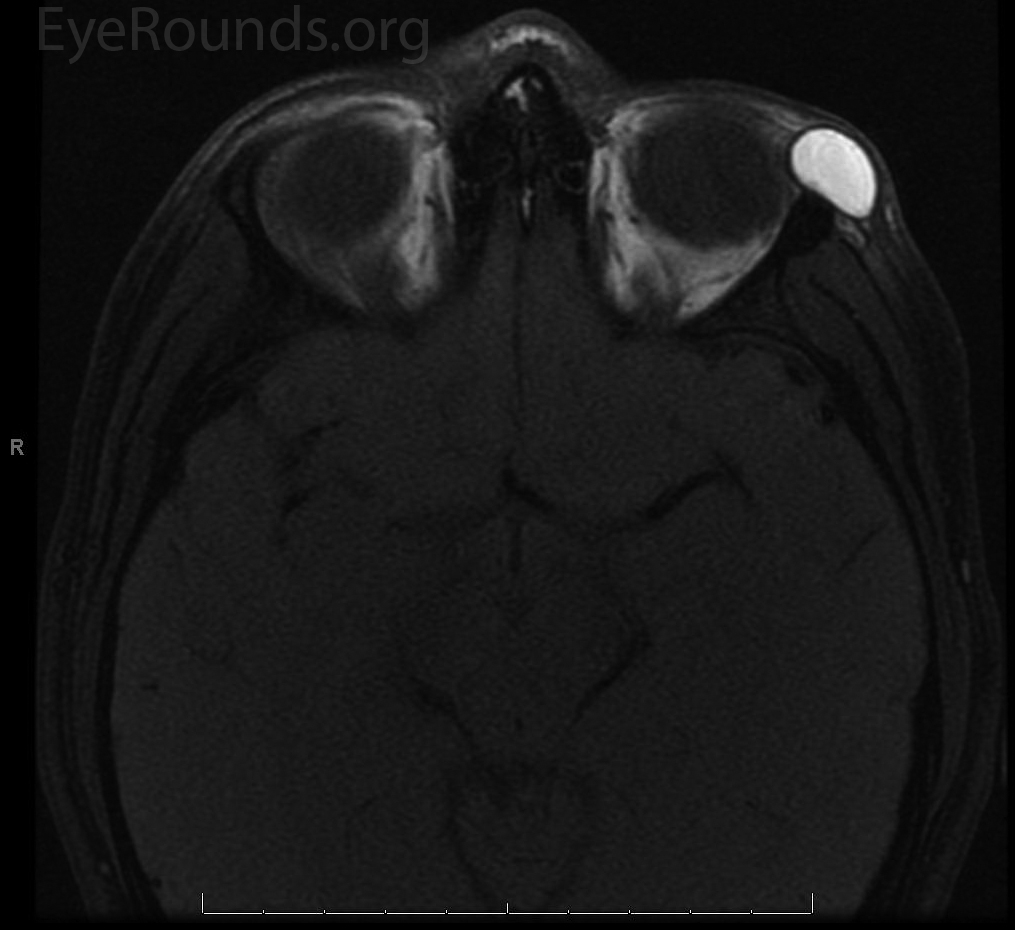 MRI of preseptal orbital dermoid cyst