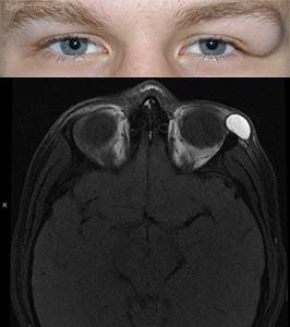 Orbital dermoid cyst