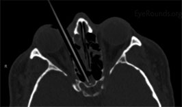 Orbital foreign body