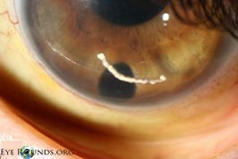 Corneal edema secondary to dexamethasone implant (Ozurdex®) migration into the anterior chamber