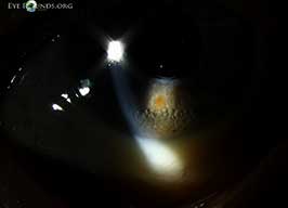 Retained anterior chamber perfluoro-N-octane (PFO) bubbles following vitrectomy for retinal detachment