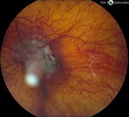 Persistent fetal vasculature (PFV) previously called persistent hyperplastic primary vitreous (PHPV)