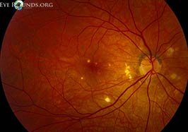 Punctate inner choroiditis