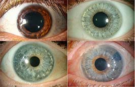 Penetrating keratoplasty (PK)