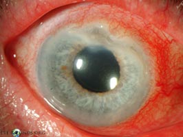 Peripheral ulcerative keratitis (PUK)