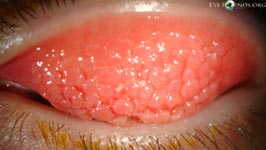 Vernal keratoconjunctivitis, palpebral