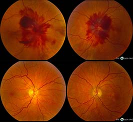 Papilledema
