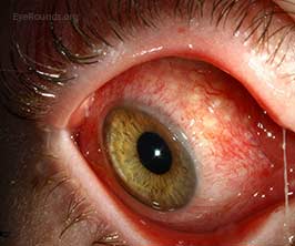 Parinaud oculoglandular syndrome
