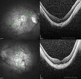 Pathologic myopia with bilateral posterior staphylomas
