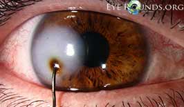 Penetrating ocular trauma