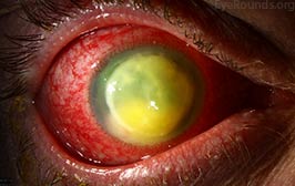 Pseudomonas keratitis