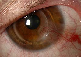 Pseudopterygium in the setting of intrastromal corneal ring segments (Intacs)