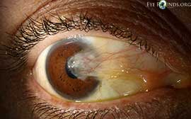 pterygium