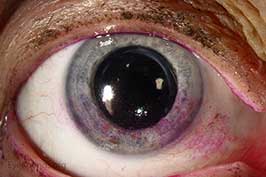 Punctate epithelial erosions (PEE) secondary to exposure keratopathy