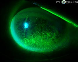 Punctate epithelial erosions (PEE) secondary to exposure keratopathy