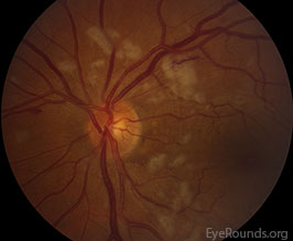 Purtscher retinopathy