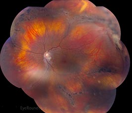 Radial Lattice Degeneration in Stickler's syndrome