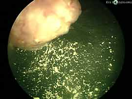 Vitreous seeding from retinoblastoma