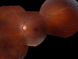 Retinal Periphlebitis