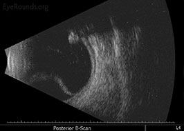 Retinal detachment with chronic intraocular foreign body