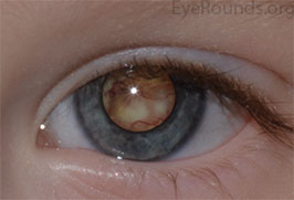 Retinoblastoma causing leukocoria