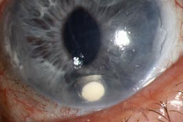 Retisert migration into the anterior chamber