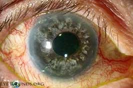 Ring Melanoma