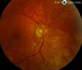 Superior segmental optic nerve hypoplasia (SSONH) / topless disc syndrome