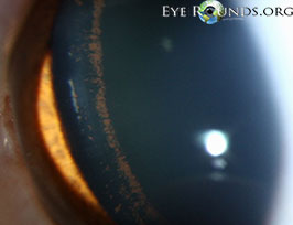 Scheie stripe in pigment dispersion syndrome