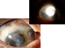 Scleromalacia with transillumination defect in the setting of chronic scleral buckle exposure
