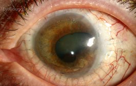 Penetrating sclerokeratoplasty