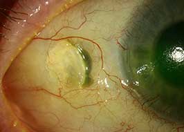 Scleromalacia in the Setting of Rheumatoid Arthritis