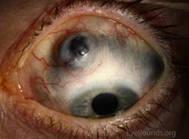 Scleromalacia perforans