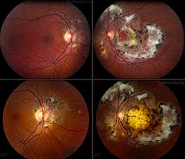 Serpiginous choroidopathy